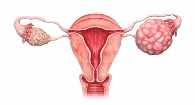 El cáncer de ovario supone el 2,9 % de todos los tumores en mujeres en la Comunitat Valenciana